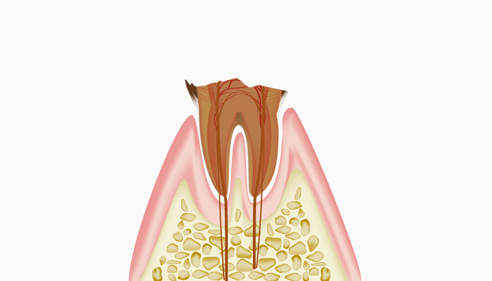 歯根まで達した虫歯