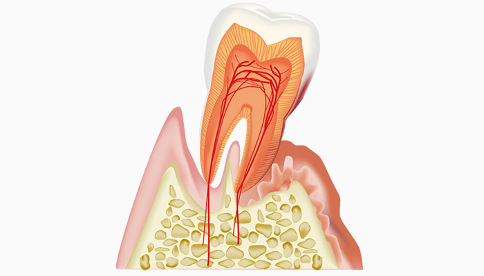 中等度歯周炎（歯周ポケットの深さ5～7mm）